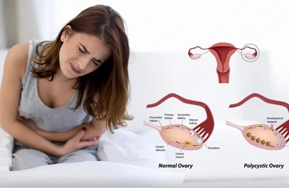 تنبلی تخمدان یک اختلال هورمونی شایع در زنان