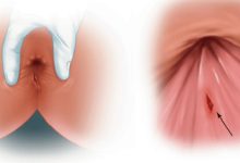 بهترین مرکز درمان شقاق فیشر در تهران و اهواز | ایران مدیکال سنتر