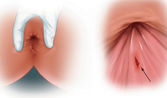 بهترین مرکز درمان شقاق فیشر در تهران و اهواز | ایران مدیکال سنتر